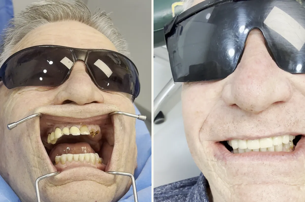 David before and after his full arch dental implants