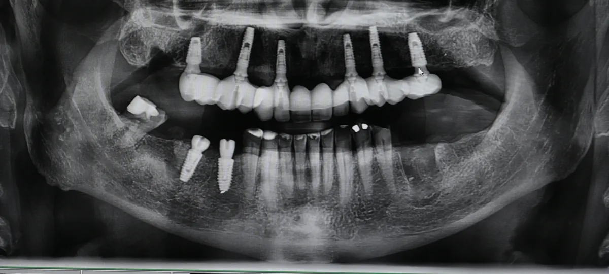 Panoramic X-ray showing six implants in the upper jaw supporting a full arch bridge