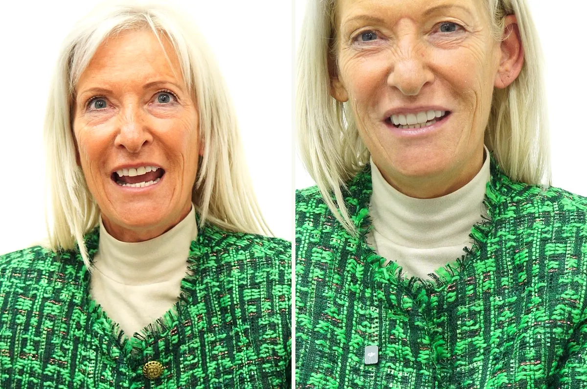 June smiling before treatment, and after her eight composite veneers