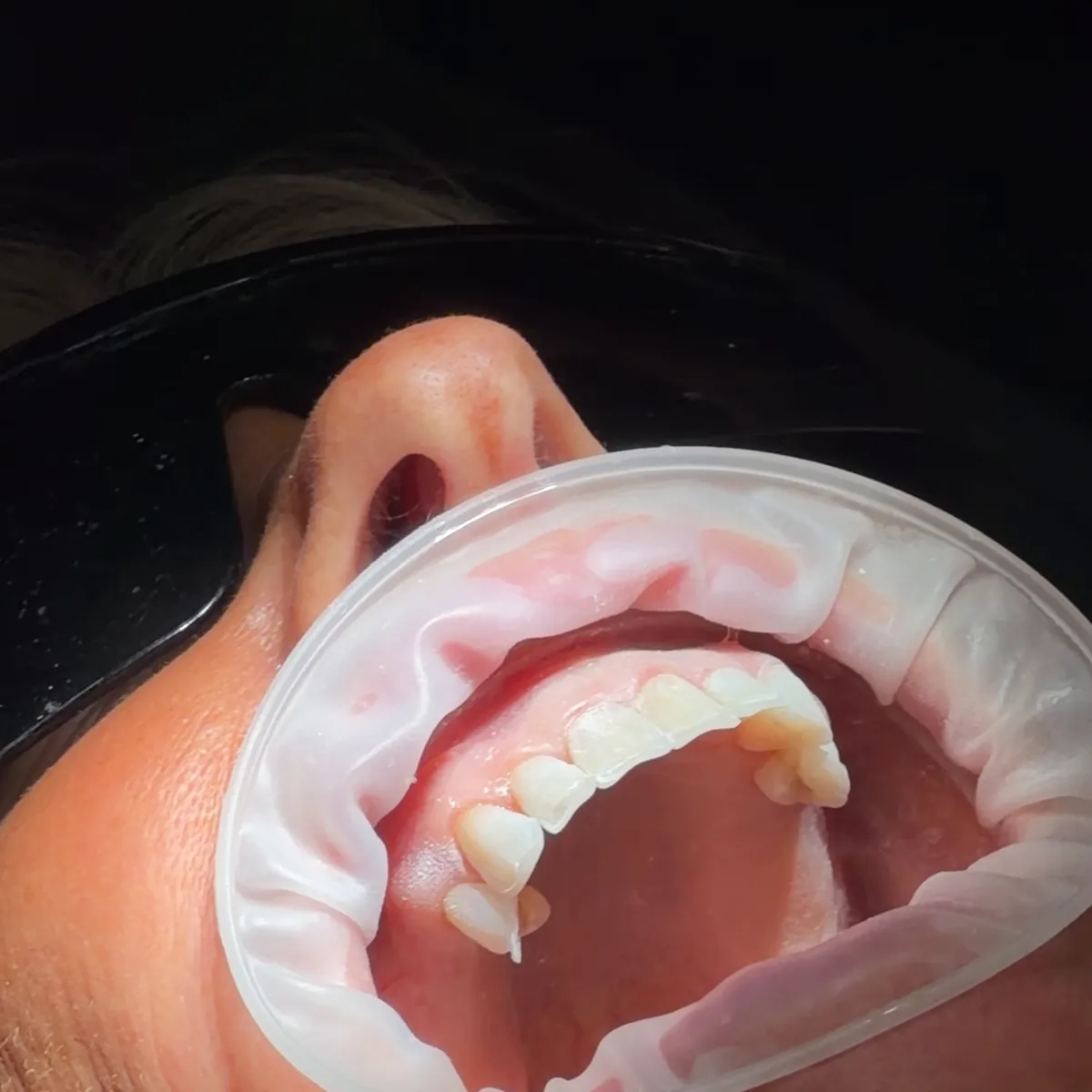 June's upper front teeth before treatment, with a cheek retractor in place