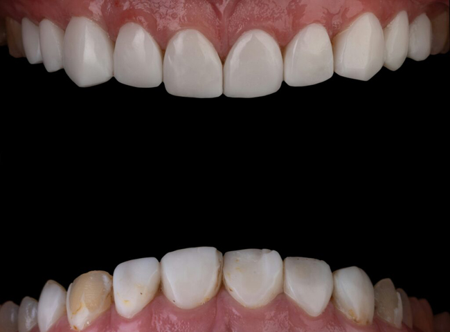 composite-bonding-dental-Deepcar