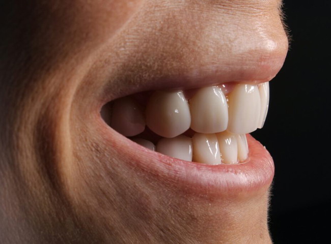 dental-veneer-Deepcar