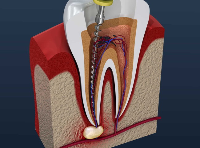 root-canal-dental-Deepcar